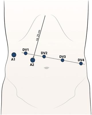 Can robotic gastric bypass be considered a valid alternative to laparoscopy? Our early experience and literature review